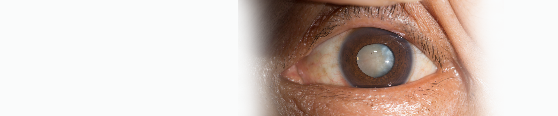 Cataract Services Banner
