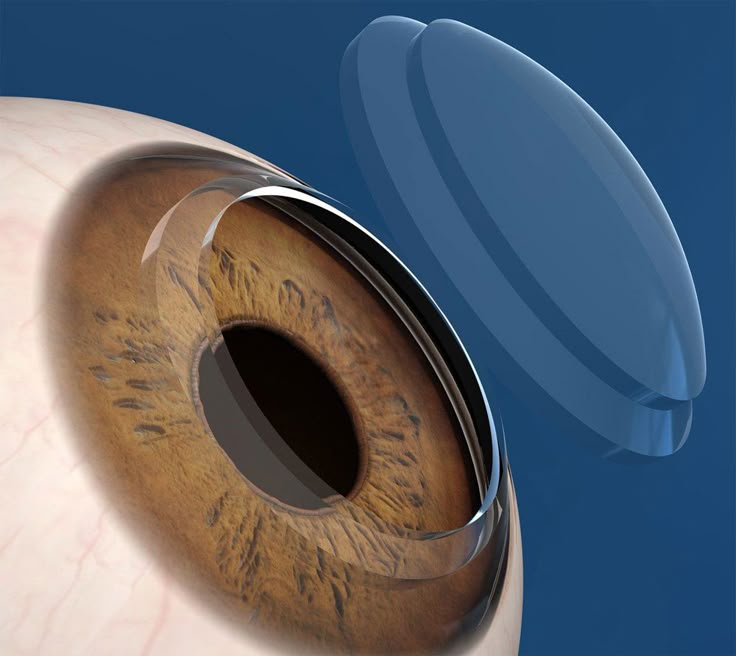Cornea Treatment